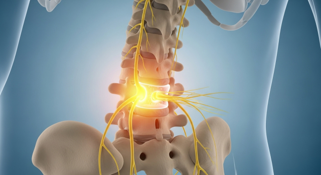 목과 허리에서 손발까지 이어지는 신경 경로와 저림을 표현한 의료 일러스트 이미지