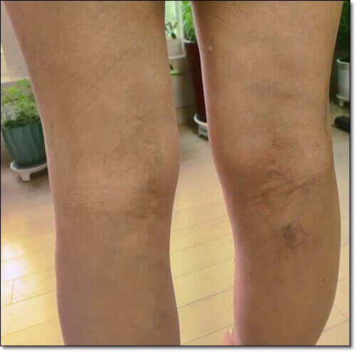 하지정맥류 환자