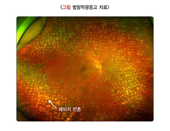 당뇨망막병증
