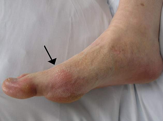 통풍은 특정 위험 요인을 가진 사람들에게서 더 자주 발생