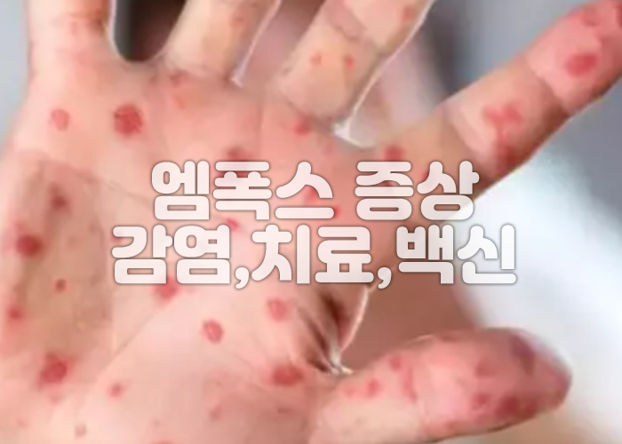 엠폭스로 인해 손에 발진이 나타나 있는 이미지