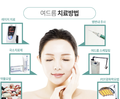 여드름치료방법