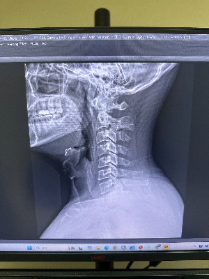 방사선사 모니터에서 확인되는 경추 X-ray 측면(Lateral) 촬영 영상