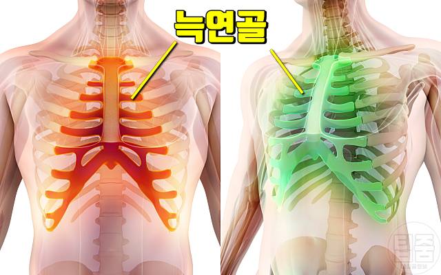 운동 가슴통증 원인 운동후 가슴통증 흉통 늑연골염