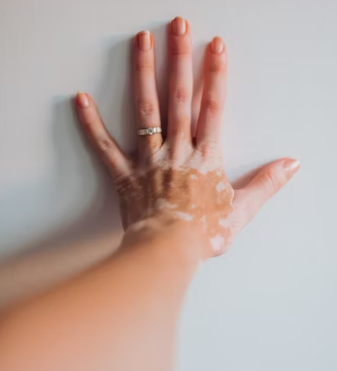 아토피 피부염 진단 기준 치료법 합병증