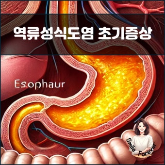 역류성 식도염 치료 및 관리방법 알아보기
