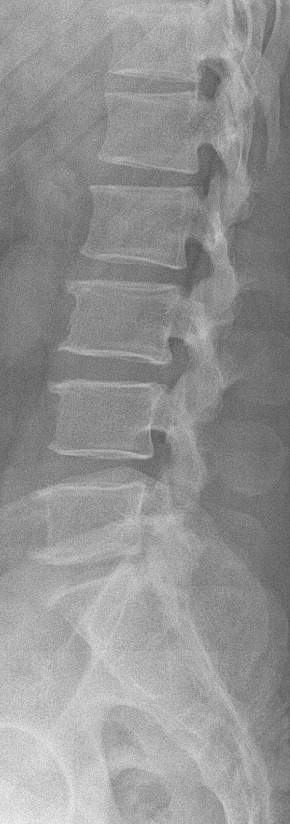 편평등(flat back)