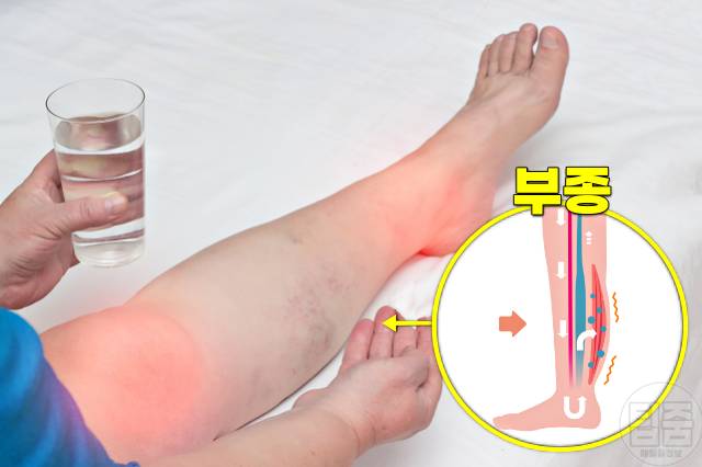 소변거품 어느정도 요독증 증상 손발 눈 주위 붓기