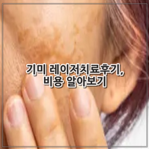 기미 레이저치료후기, 비용 알아보기