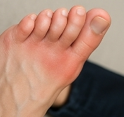 통풍에 좋은 음식