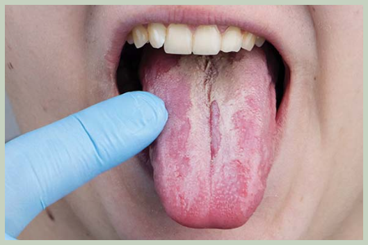 혓바닥 백태 생기는 이유