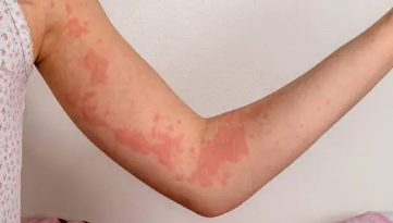 피부 붉은반점 19