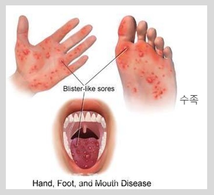 수족구병