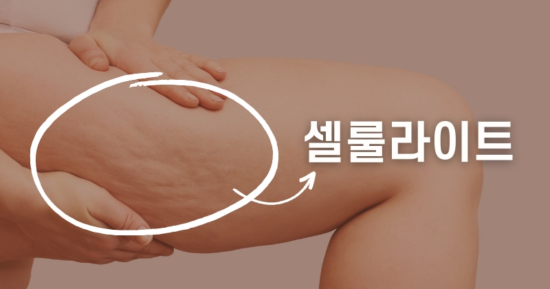 셀룰라이트