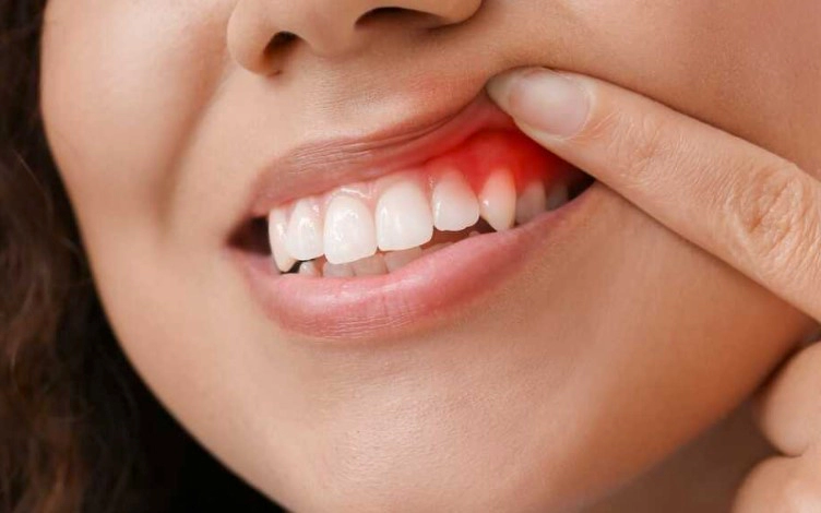 치주병 원인 증상 진행과정 치료 예방법 정리