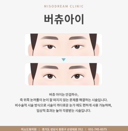 아이버츄 비용 후기 가격 부작용 피부과 시술 원리