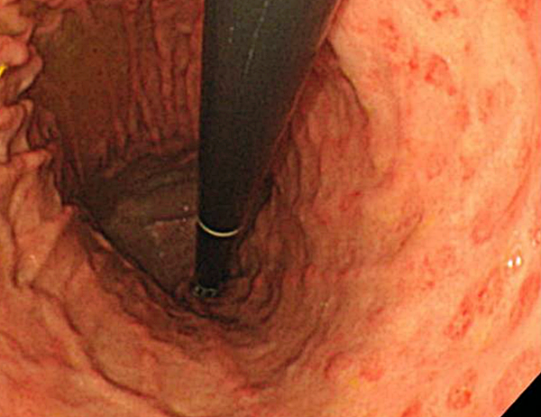 미란성위염2_출처:EndoToday