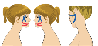 안면신경마비 완화