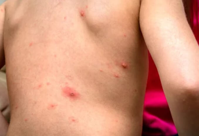 대상포진 초기증상 대상포진 조기치료 대상포진 초기증상 및 조기치료