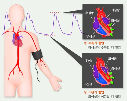고혈압