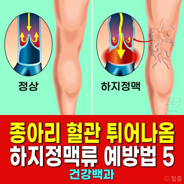 종아리 혈관 튀어나옴 하지정맥류 증상 예방