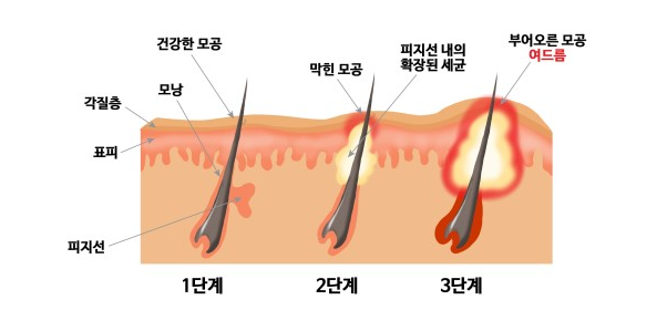 여드름