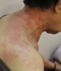 대상포진 초기증상 10가지