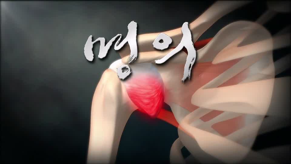 명의 오십견 유발하는 갱년기, 잘못된 자세, 당뇨, 갑상선, 유방암 어깨 관절 통증 치료 방법 병원 추천 소개