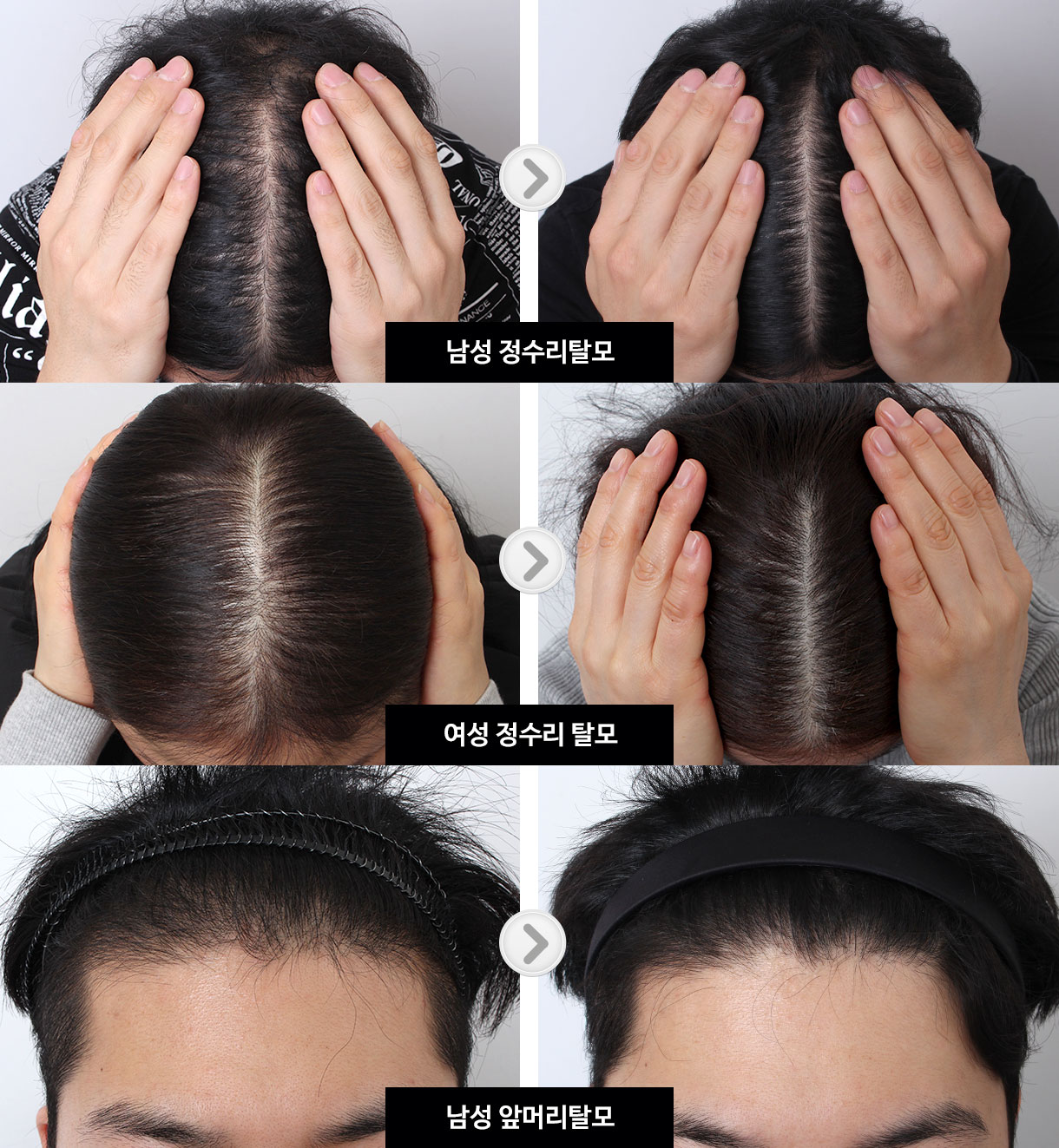 탈모-샴푸-비교