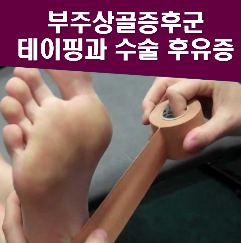 부주상골증후군 및 평발 테이핑 하는법, 수술 후유증과 재활