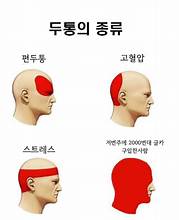 두통의종류