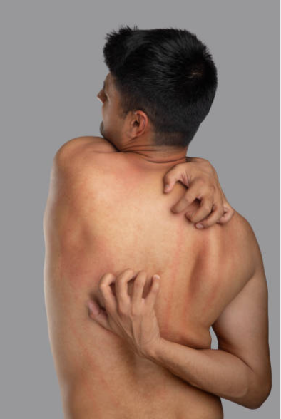 간지럼증과 관련된 사진1