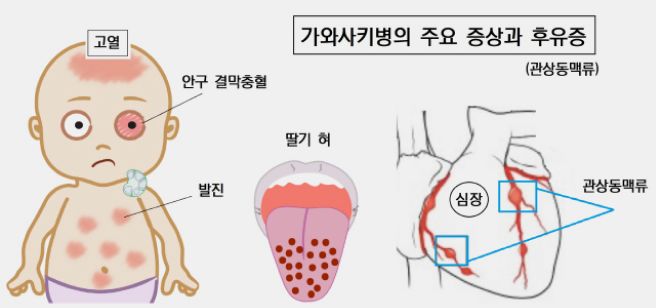 가와사키병 증상