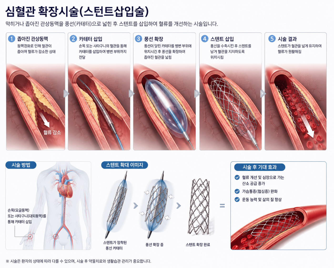 심혈관 확장시술