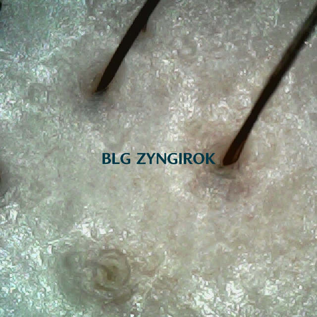 탈모 극복 프로젝트 - 정수리와 이마 사이 두피 모습이다.