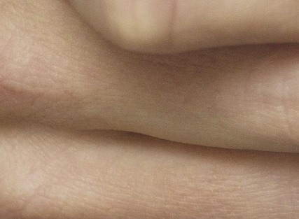 1형당뇨 2형당뇨