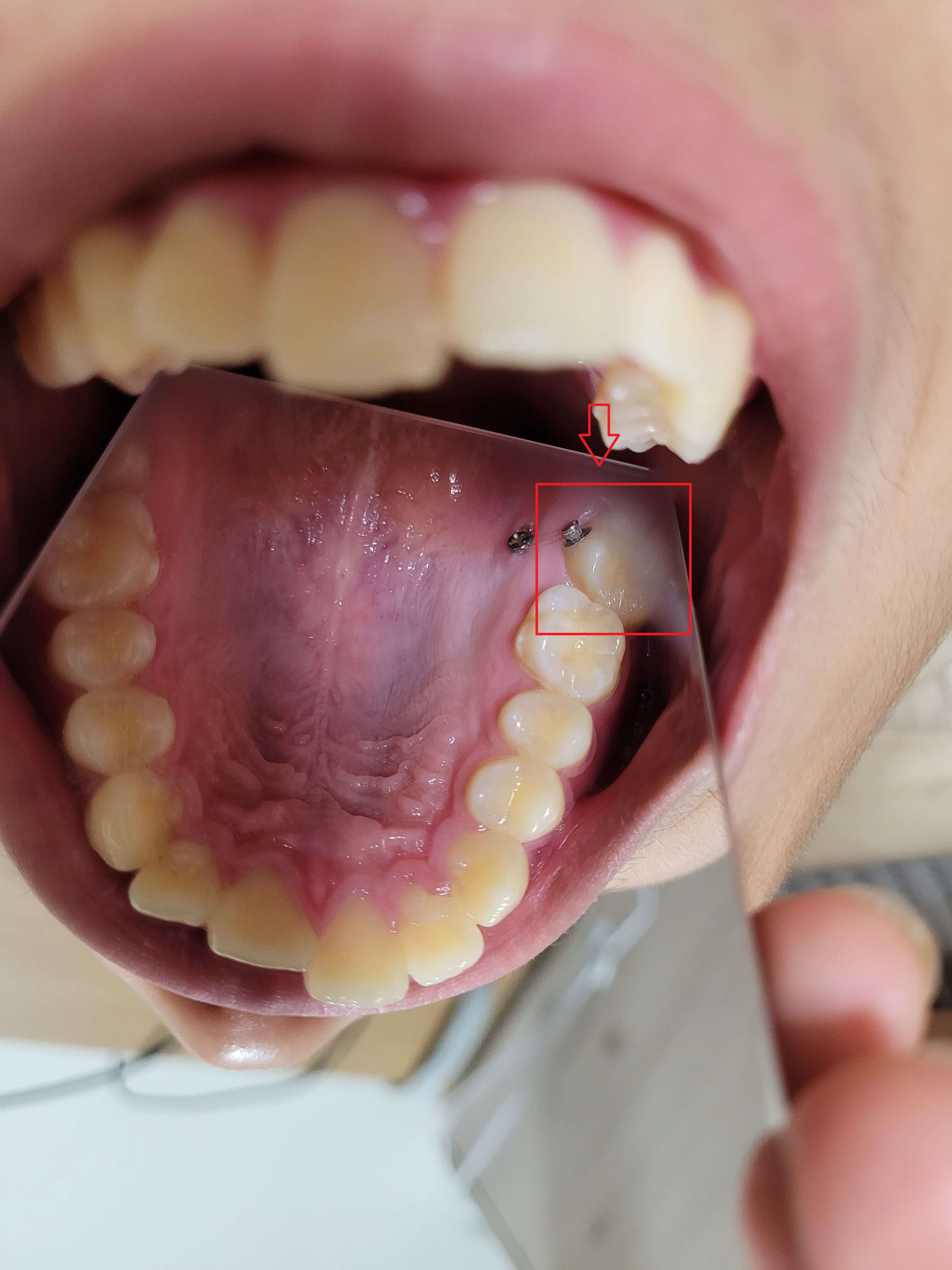 부정교합 가위교합 과개교합 치아교정 후기13