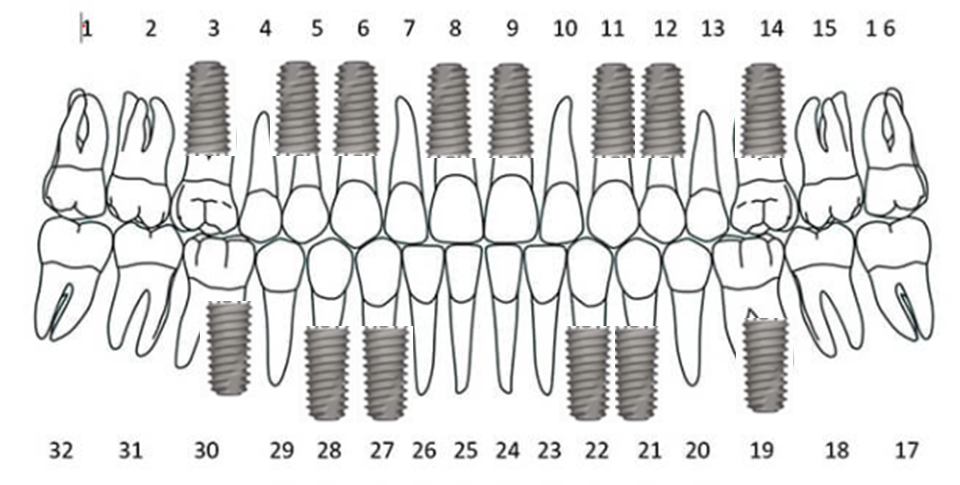 전체임플란트개수2