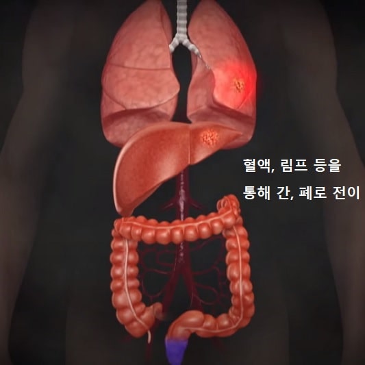 대장암 증상