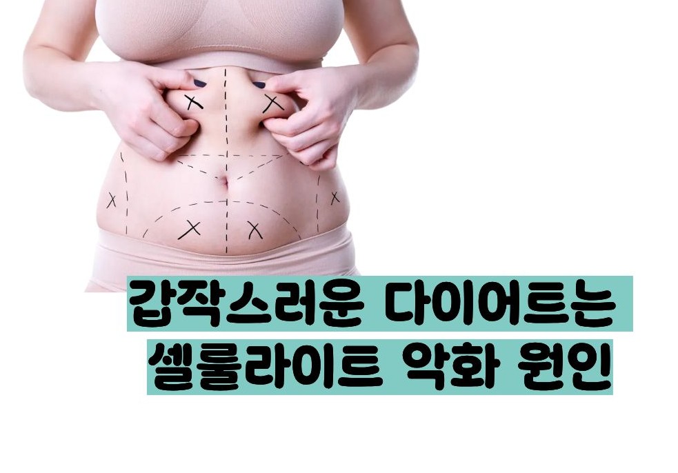셀룰라이트 없애는 법