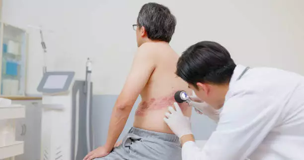 대상포진 초기증상 치료방법