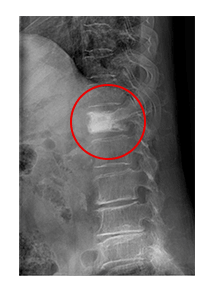 척추성형술 시술 후
