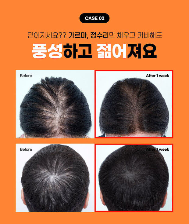 탈모현상과 치료