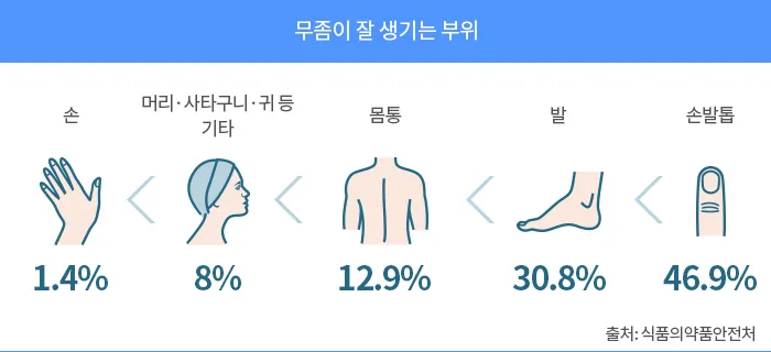 발톱무좀 없애는 방법