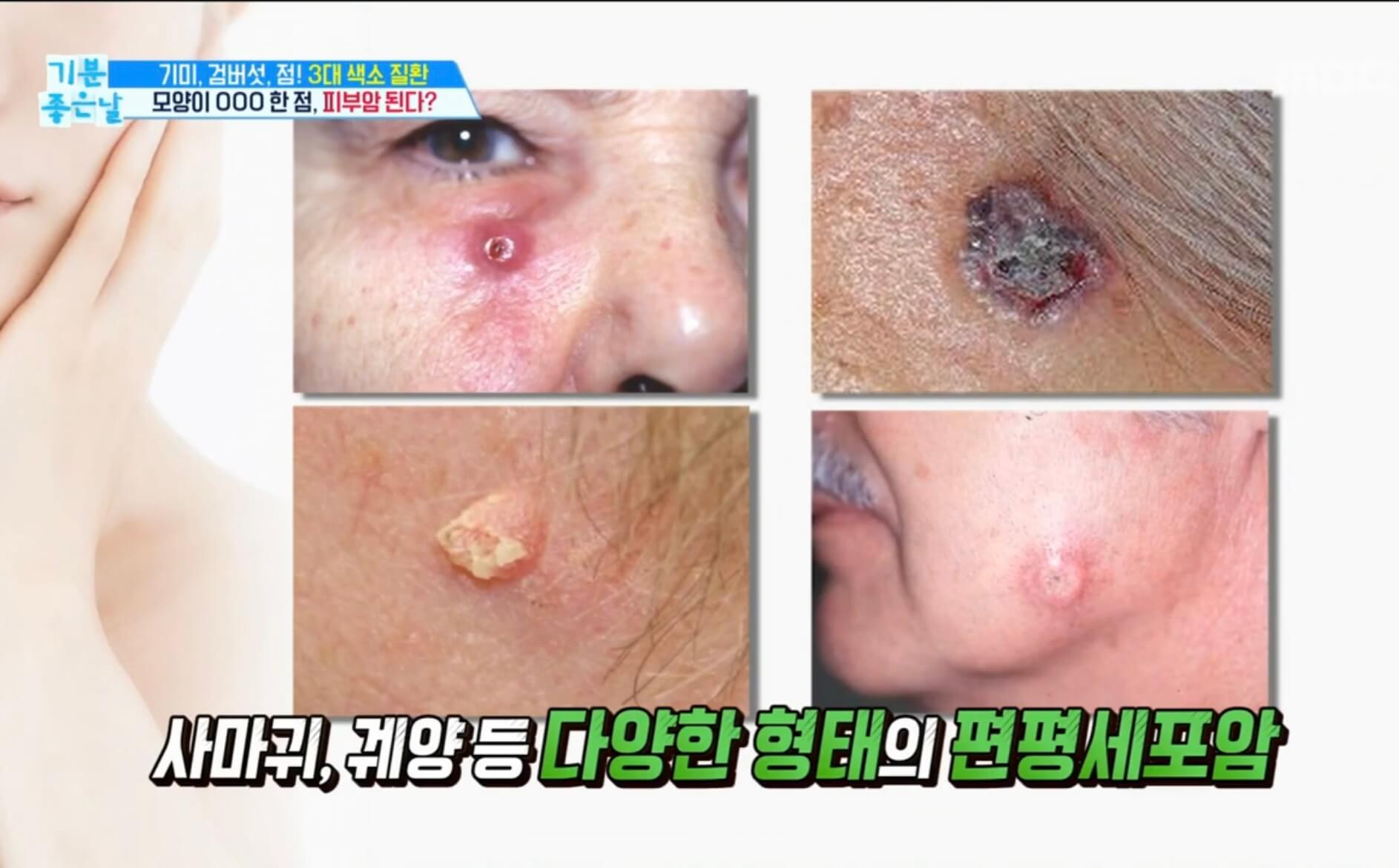 피부암