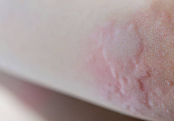 미녹시딜 부작용