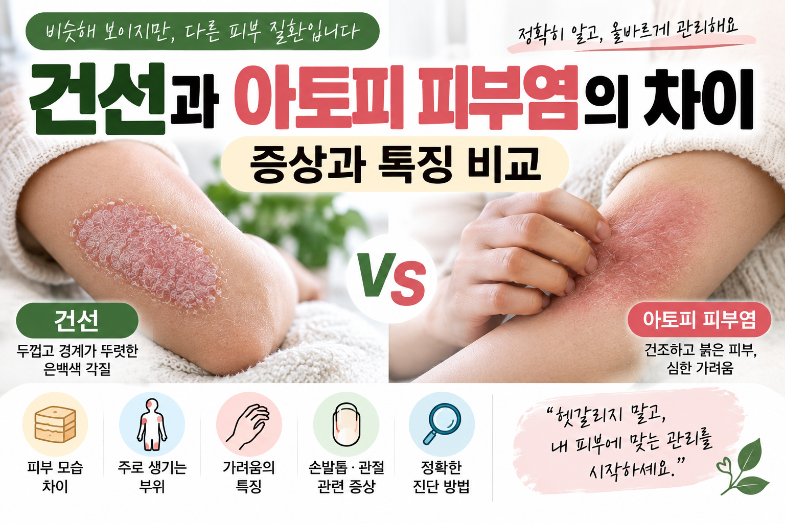 건선과 아토피 피부염의차이