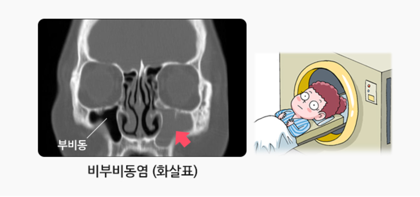 부비동염 내시경 수술