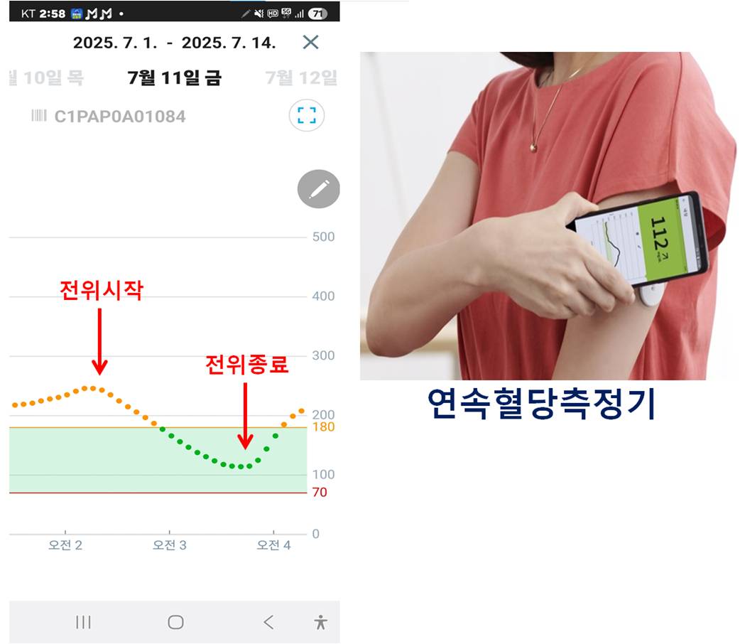 연속혈당측정기를 착용하고 전위발생기 치료 중 혈당수치가 정상으로 내려간 화면