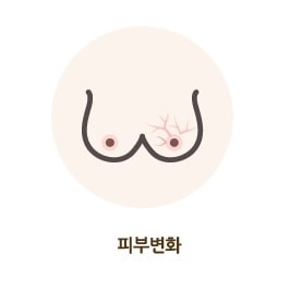 유방암 자가 진단